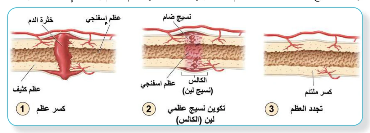 الشكل (16): خطوات التئام العظم المكسور