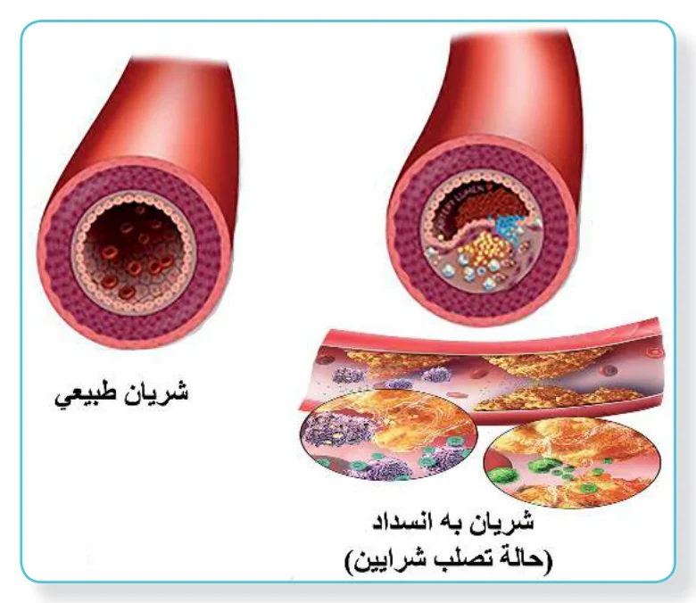 الشكل (10): تصلب الشرايين