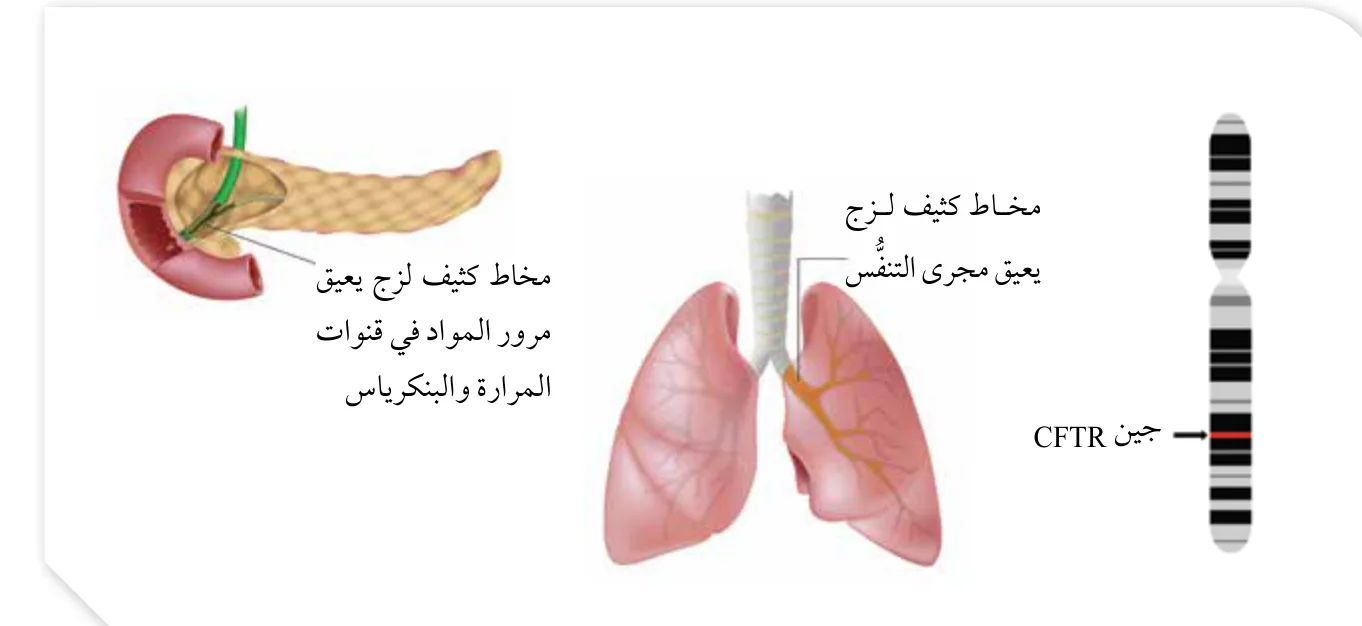 الشكل (37): موقع جين CFTR على الكروموسوم رقم (7) وبعض أعراض مرض التليف الكيسي.