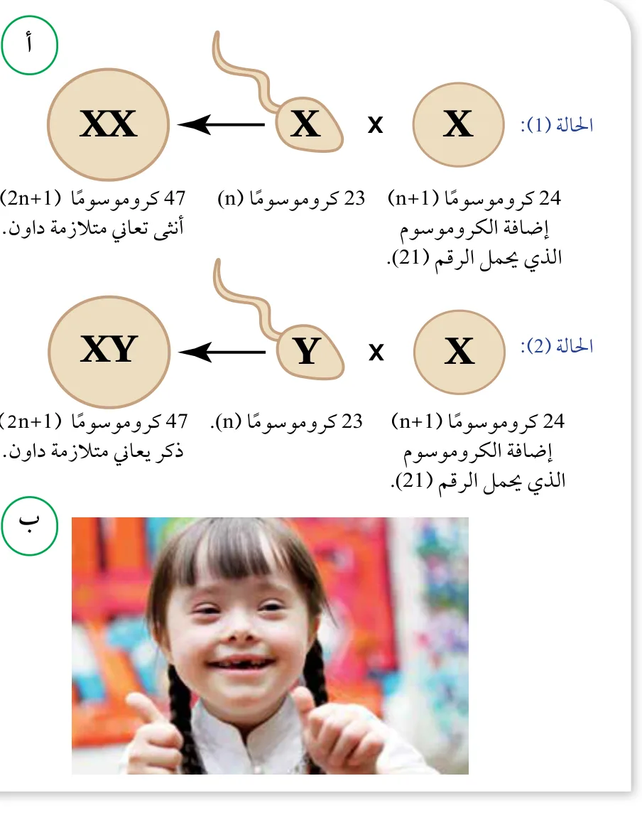 الشكل (38): أ. حالتا إخصاب نتج من كلّ منهما ذكر وأنثى يعانيان متلازمة داون. ب. أنثى تعاني متلازمة داون.
