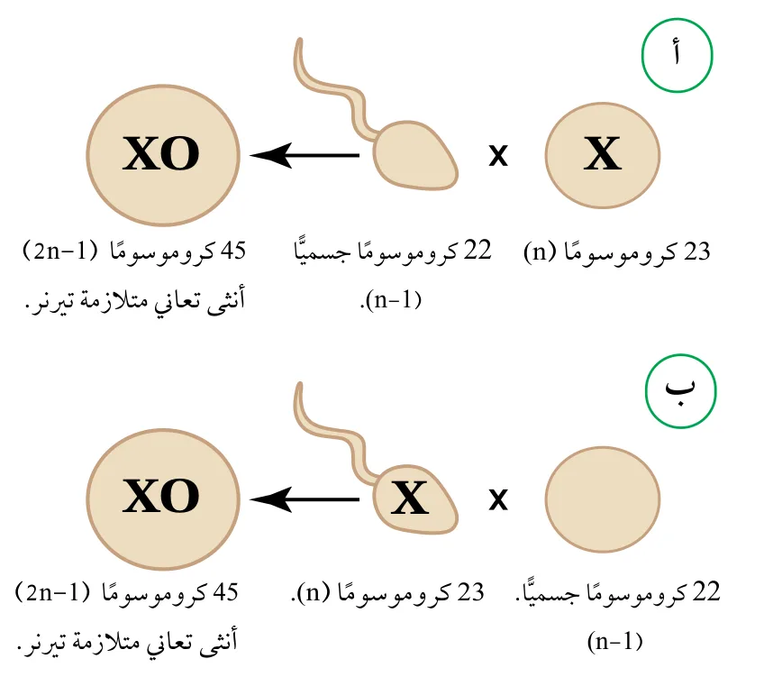 الشكل (39): حالتا إخصاب نتج من كلّ منهما أنثى تعاني متلازمة تيرنر. أستنتج: أيّ الجاميتات نتج من عدم انفصال الكروموسومين الجنسيين في الحالة (أ) والحالة (ب)؟