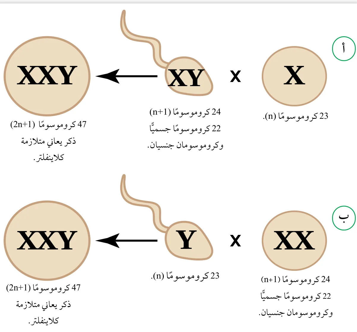 الشكل (40): حالتا إخصاب نتج من كلّ منهما ذكر يعاني متلازمة كلاينفلتر. أستنتج: أيّ الحالتين تدلّ على عدم انفصال الكروموسومين الجنسيين أثناء تكوين الجاميتات الذكرية؟ أُبرّر إجابتي.