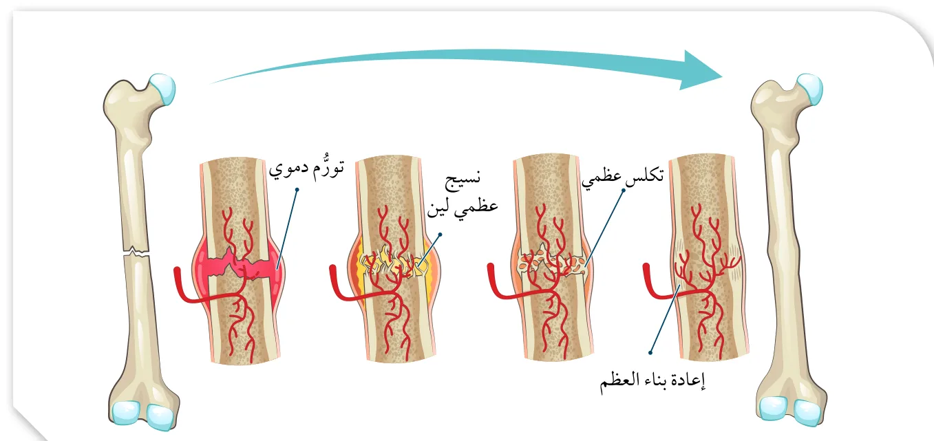 الشكل (9): إعادة بناء العظم المكسور.