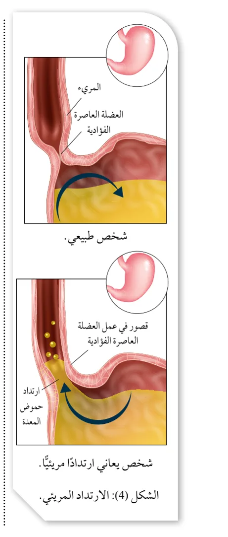 الشكل (4): الارتداد المريئي.